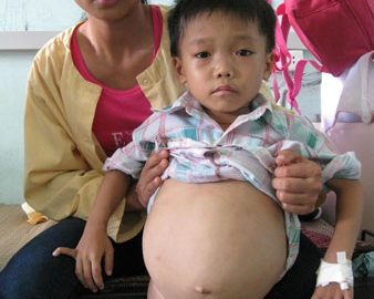 Ánh mắt buồn của cậu bé 8 tuổi mắc bệnh hiểm nghèo