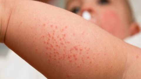 Sốt xuất huyết đang ở đỉnh dịch, 25 ca tử vong