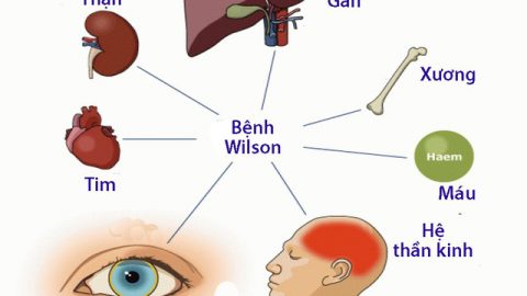 Bệnh Wilson ở trẻ em
