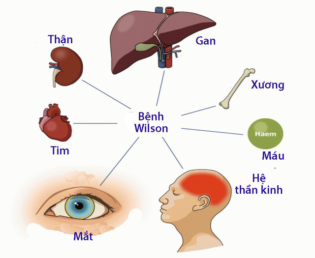 Tất tần tật về bệnh wilson rối loạn chuyển hoá đồng và điều trị