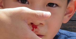 Sự nhạy cảm của mạch máu trong mũi trẻ em khi có thời tiết hanh khô gây ra chảy máu cam là một nguyên nhân không?
