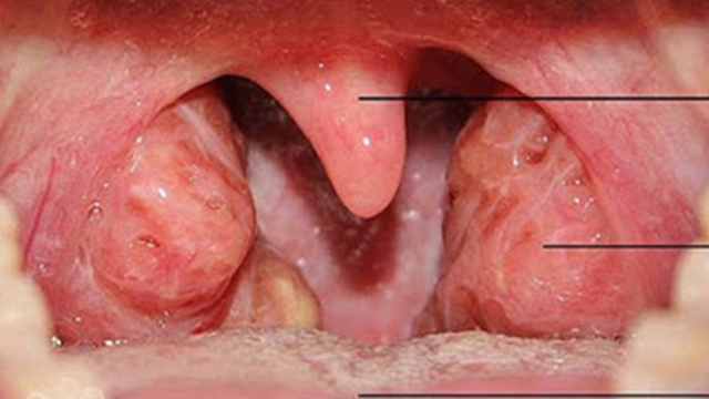 Tìm hiểu về phương pháp nạo amidan là gì và cách lây lan trong cơ thể