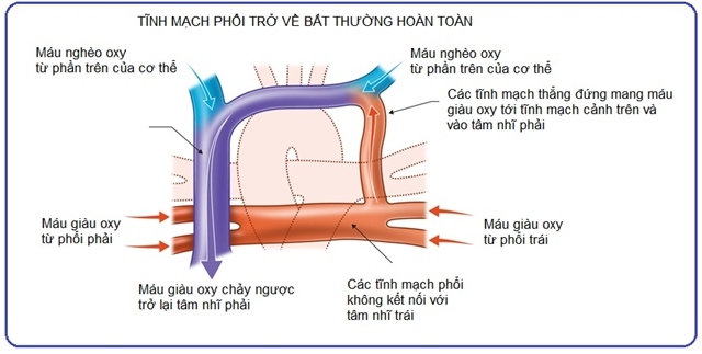 Cứu sống bé trai 2 tháng tuổi dị tật tim bẩm sinh phức tạp