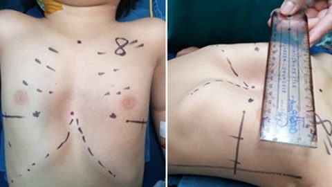 Những thông tin cần biết về bệnh lõm lồng ngực ở trẻ em