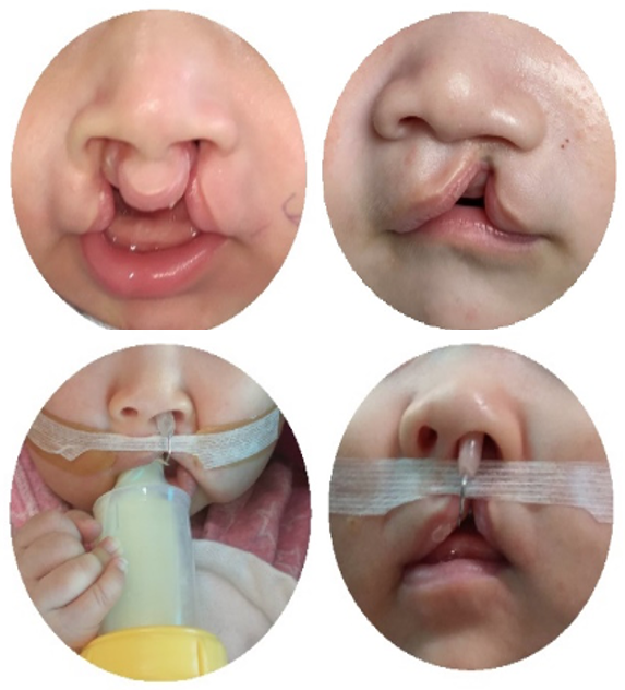 Kiến thức cơ bản và Chăm sóc ban đầu cho trẻ khe hở môi – vòm miệng