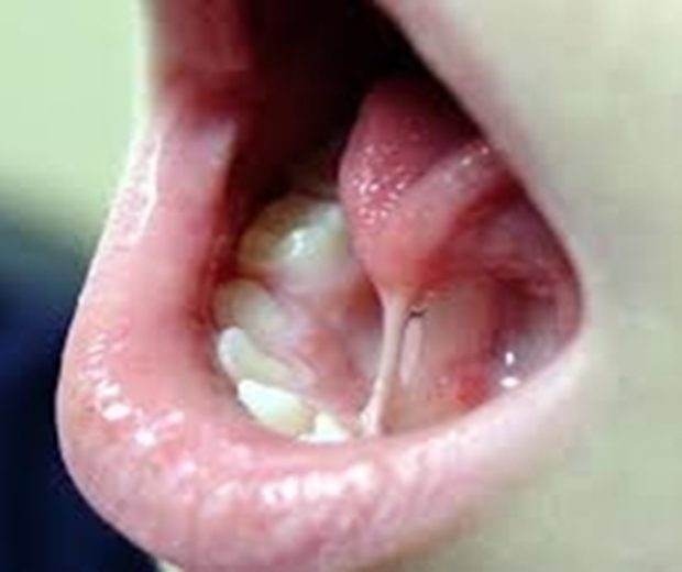 Dính lưỡi (Ankyloglossia) ở trẻ em
