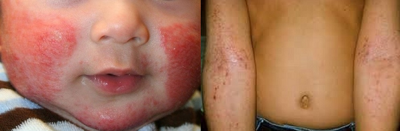 Cách phòng tránh và điều trị hình ảnh viêm da ở trẻ em hiệu quả