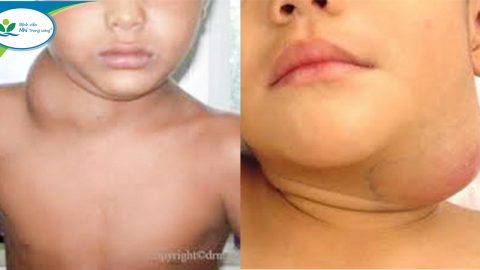 Khối vùng đầu – cổ ở trẻ em: Cách phát hiện và hướng xử trí