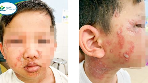 Viêm da tiếp xúc do kiến ba khoang