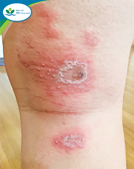 Nhấn vào ảnh để phóng to https://benhviennhitrunguong.gov.vn/wp-content/uploads/2022/03/Ton-thuong-dang-hon.jpg?w=900?w=1130