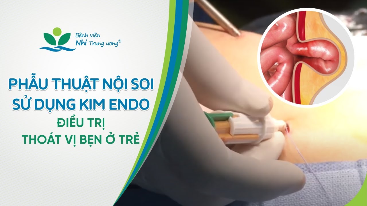Phẫu thuật nội soi sử dụng kim Endo điều trị thoát vị bẹn ở trẻ