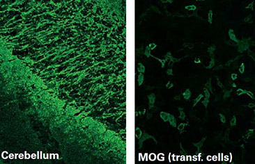 Kháng thể kháng Myelin Oligodendrocyte Glycoprotein (MOG) – Bệnh tự miễn thần kinh