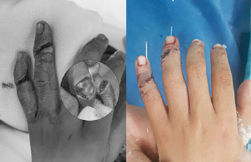 Phụ anh nấu cơm, bé trai 7 tuổi bị đứt gần rời ngón tay – Được các bác sĩ phẫu thuật phục hồi kỳ diệu