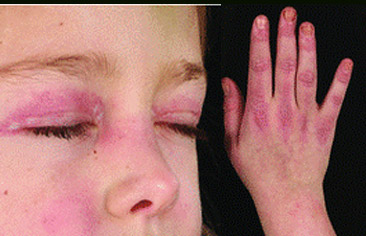 Viêm da cơ trên trẻ em – Juvenile Dermatomyositis