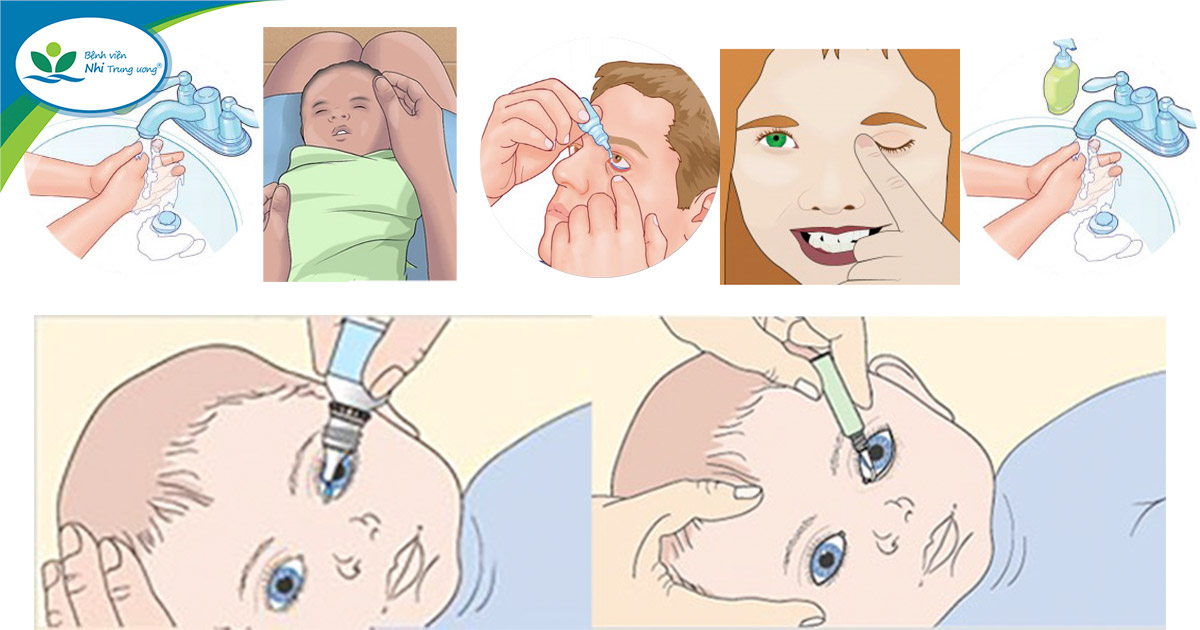Thuốc nhỏ mắt Argyrol 1% có tác dụng gì trong việc điều trị đau mắt cho trẻ sơ sinh?
