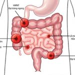 Chăm sóc hậu môn nhân tạo