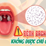 Bạch hầu: Nguyên nhân, triệu chứng, biến chứng và phòng ngừa bằng vắc-xin