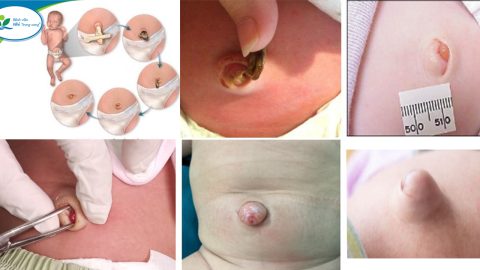 Một số dấu hiệu bất thường về rốn của trẻ sơ sinh