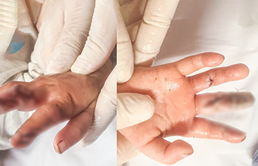 Bé gái 17 tháng tuổi bị dập nát ngón tay do máy thêu của gia đình – Cảnh báo tai nạn trẻ em trong sinh hoạt hàng ngày