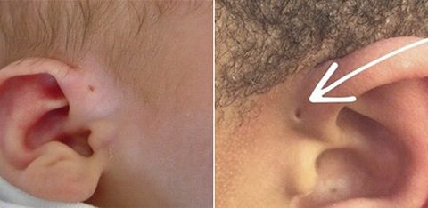Chăm sóc trước và sau phẫu thuật cho trẻ bị rò luân nhĩ