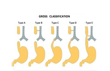 Chăm sóc người bệnh teo thực quản có lỗ rò khí – thực quản