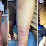 Cảnh báo mùa du lịch biển: Viêm da tiếp xúc do Sứa biển