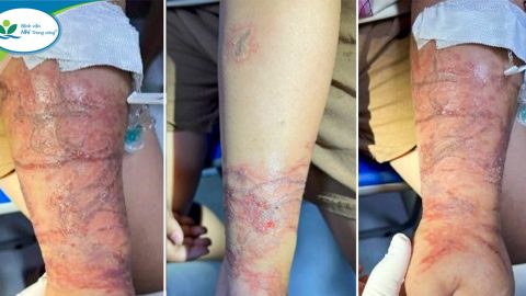 Cảnh báo mùa du lịch biển: Viêm da tiếp xúc do Sứa biển