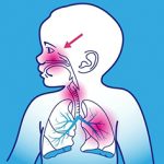 Men vi sinh và thời gian sốt trên trẻ nhiễm khuẩn đường hô hấp trên