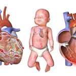 Thử nghiệm lâm sàng so sánh IVIg đơn độc và IVIg kết hợp với aspirin liều cao trong điều trị tổn thương động mạch vành