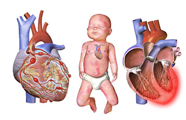 Thử nghiệm lâm sàng so sánh IVIg đơn độc và IVIg kết hợp với aspirin liều cao trong điều trị tổn thương động mạch vành