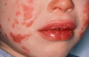 Các IVIG trong điều trị bệnh Kawasaki