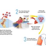 Chăm sóc dự phòng nhiễm trùng ở người bệnh ghép tế bào gốc