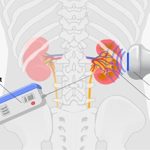 Hướng dẫn chăm sóc bệnh nhi trước và sau sinh thiết thận