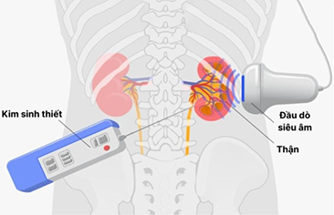 Hướng dẫn chăm sóc bệnh nhi trước và sau sinh thiết thận