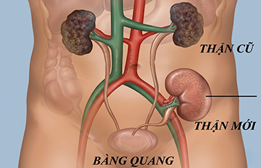 Hướng dẫn chăm sóc và theo dõi bệnh nhi tại nhà sau ghép thận