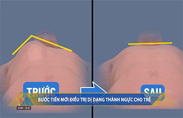 [VTV1] Bước tiến mới trong điều trị dị dạng thành ngực phức tạp ở trẻ em: Bệnh viện Nhi Trung ương làm chủ kỹ thuật nội soi sử dụng thanh đôi (Sandwich) trong phẫu thuật điều trị dị dạng lồi – lõm xương ức phức tạp ở trẻ em