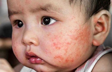 So sánh hiệu quả của methotrexate với ciclosporin trong điều trị viêm da cơ địa mức độ nặng ở trẻ em